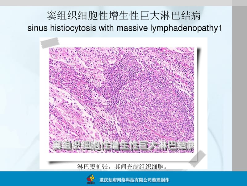 淋巴结病变的病理学图片.pdf_第2页