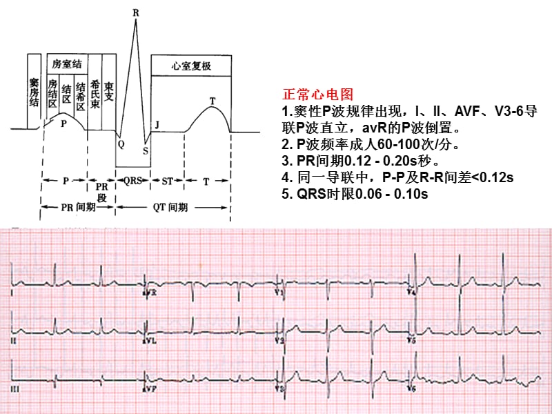 房室传导阻滞心电图的判读.ppt_第2页