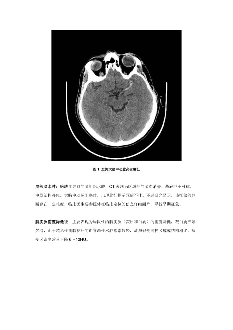 看图说话：缺血性脑卒中超急性期的影像学特点.doc_第2页