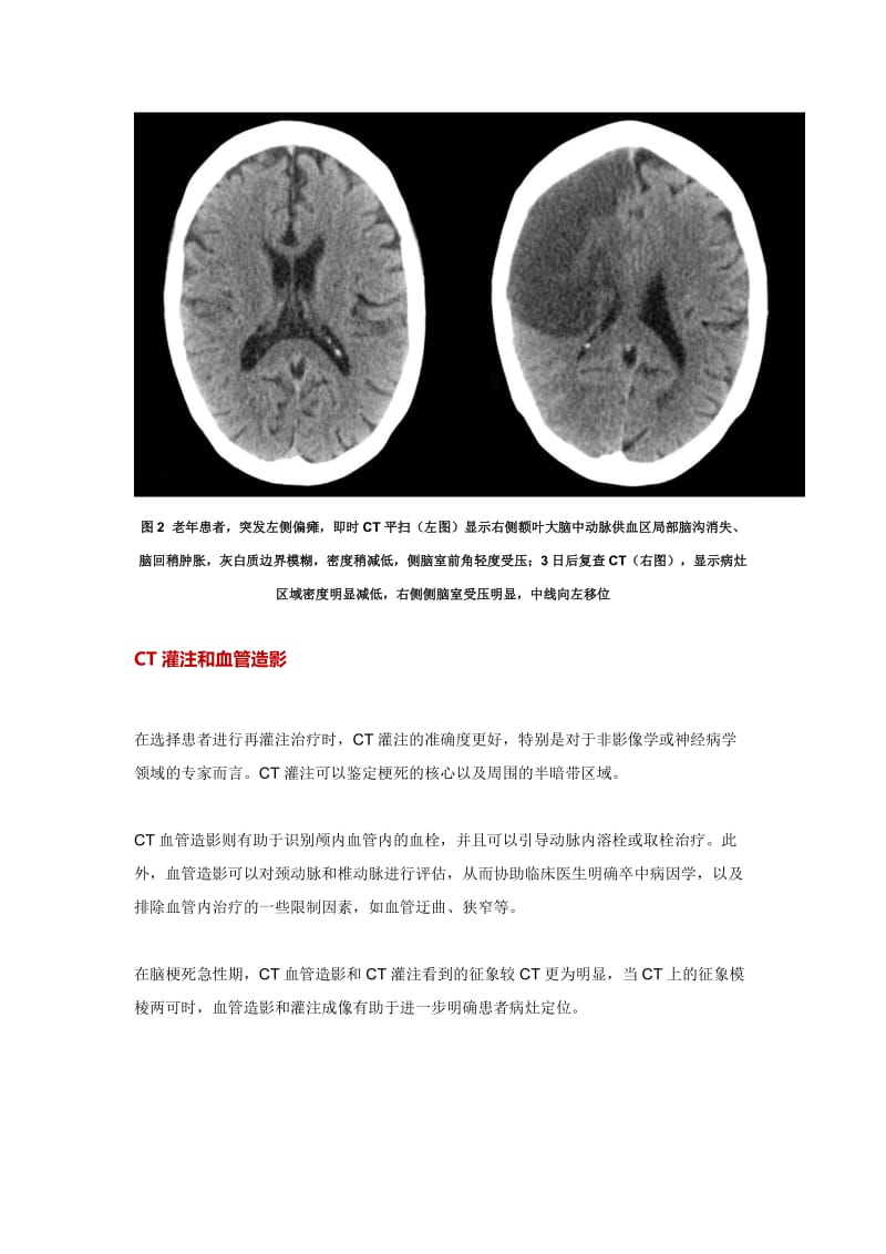 看图说话：缺血性脑卒中超急性期的影像学特点.doc_第3页