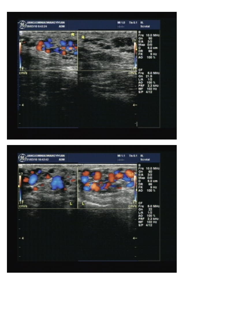 精索静脉曲张超声诊断.doc_第2页