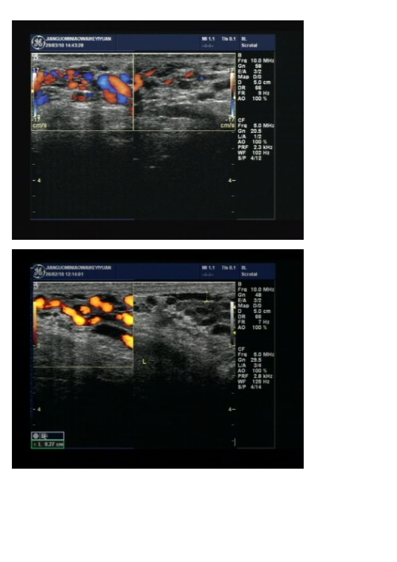 精索静脉曲张超声诊断.doc_第3页