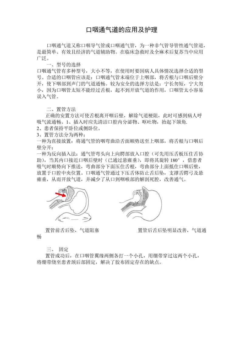 口咽通气道置管操作流程.doc_第1页