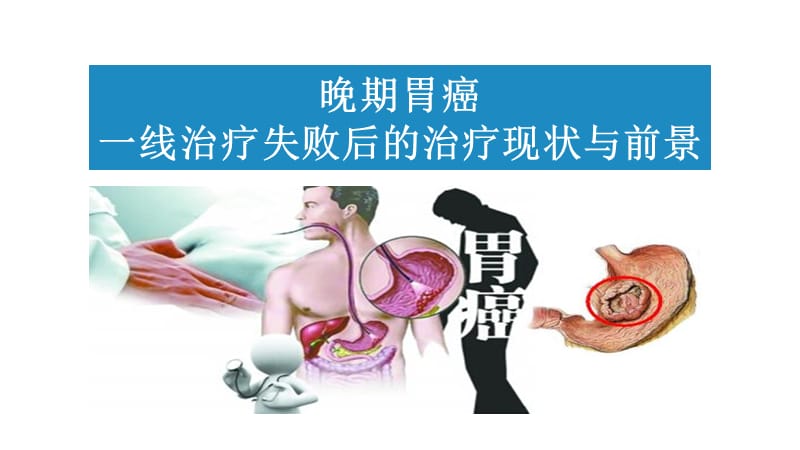 晚期胃癌治疗.ppt_第1页