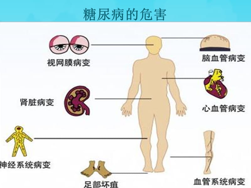 糖尿病足护理PPT.ppt_第2页