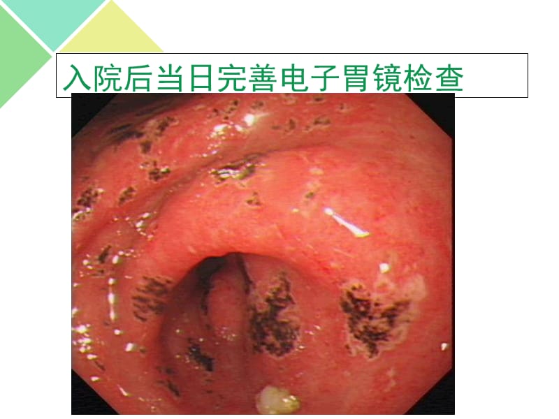 NASIDs相关胃肠道损伤的PPI临床应用.ppt_第3页