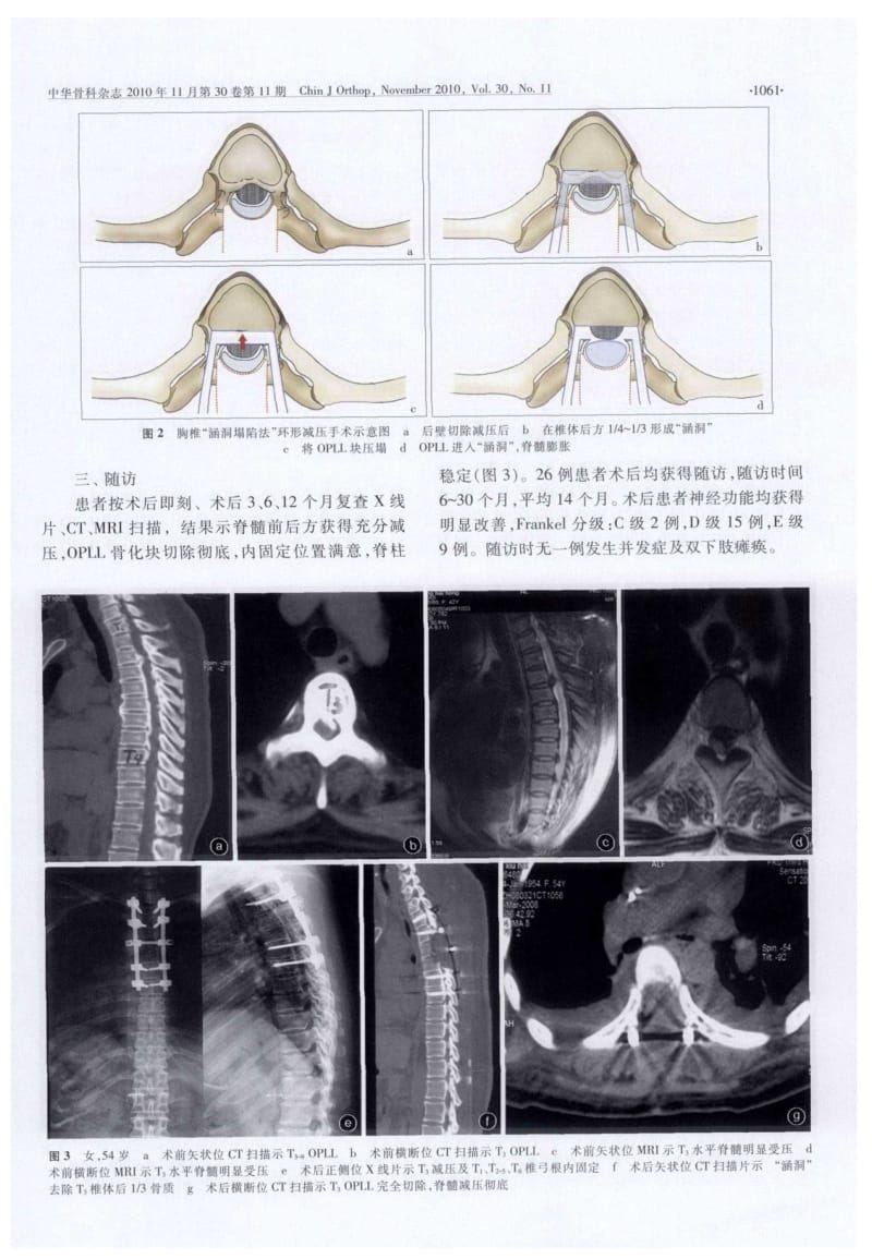 360°脊髓环形减压术治疗胸椎管狭窄症.pdf_第3页