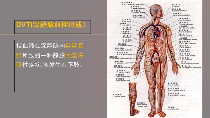 dvt的预防及护理.ppt_第2页