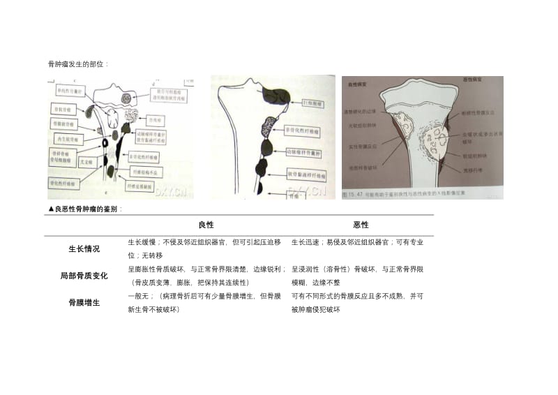 骨肿瘤鉴别诊断.doc_第1页