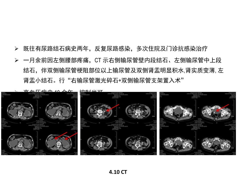 黄英姿-从重症泌尿系感染引发的思考.doc_第3页