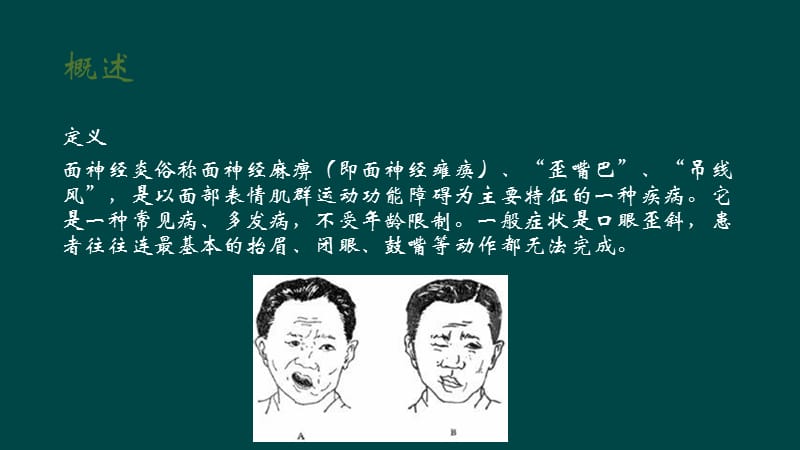 面瘫的护理查房.ppt_第3页