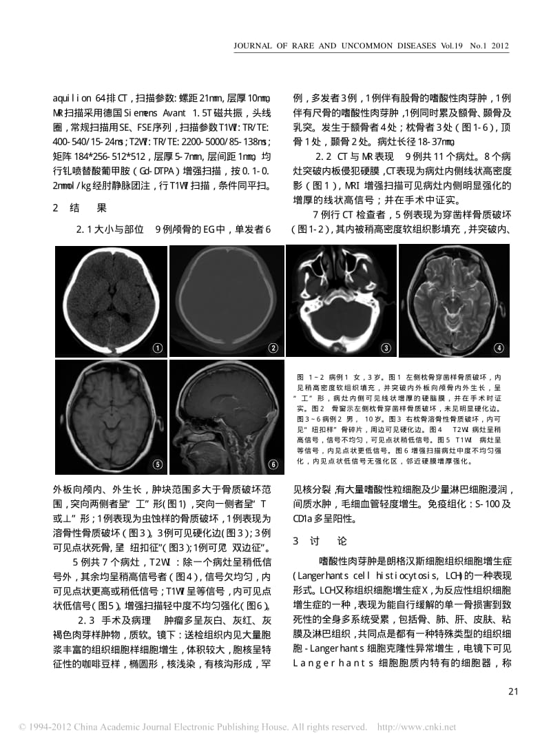 颅骨嗜酸性肉芽肿的CT与MRI诊断.pdf_第2页