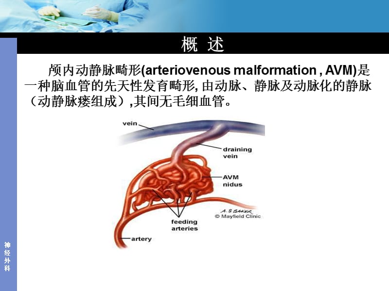 动静脉畸形AVM.ppt_第2页