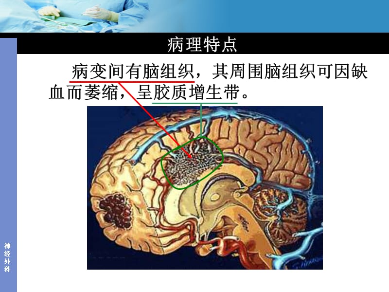 动静脉畸形AVM.ppt_第3页