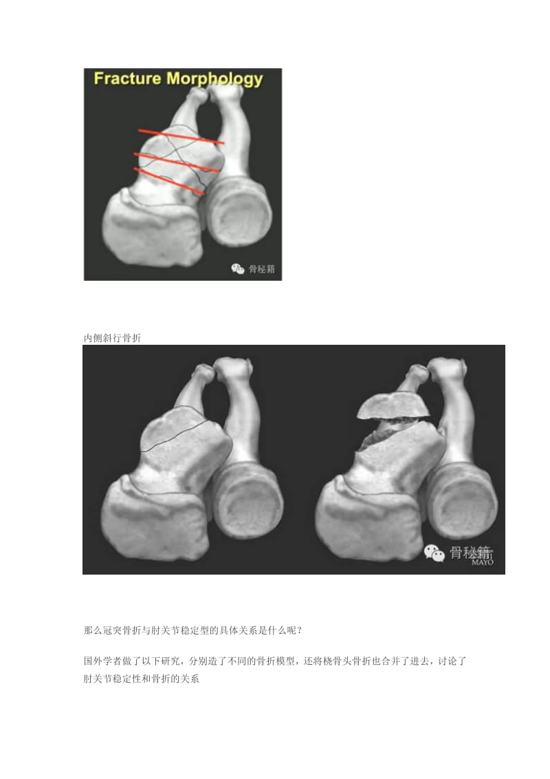 冠突骨折手术技巧.pdf_第3页