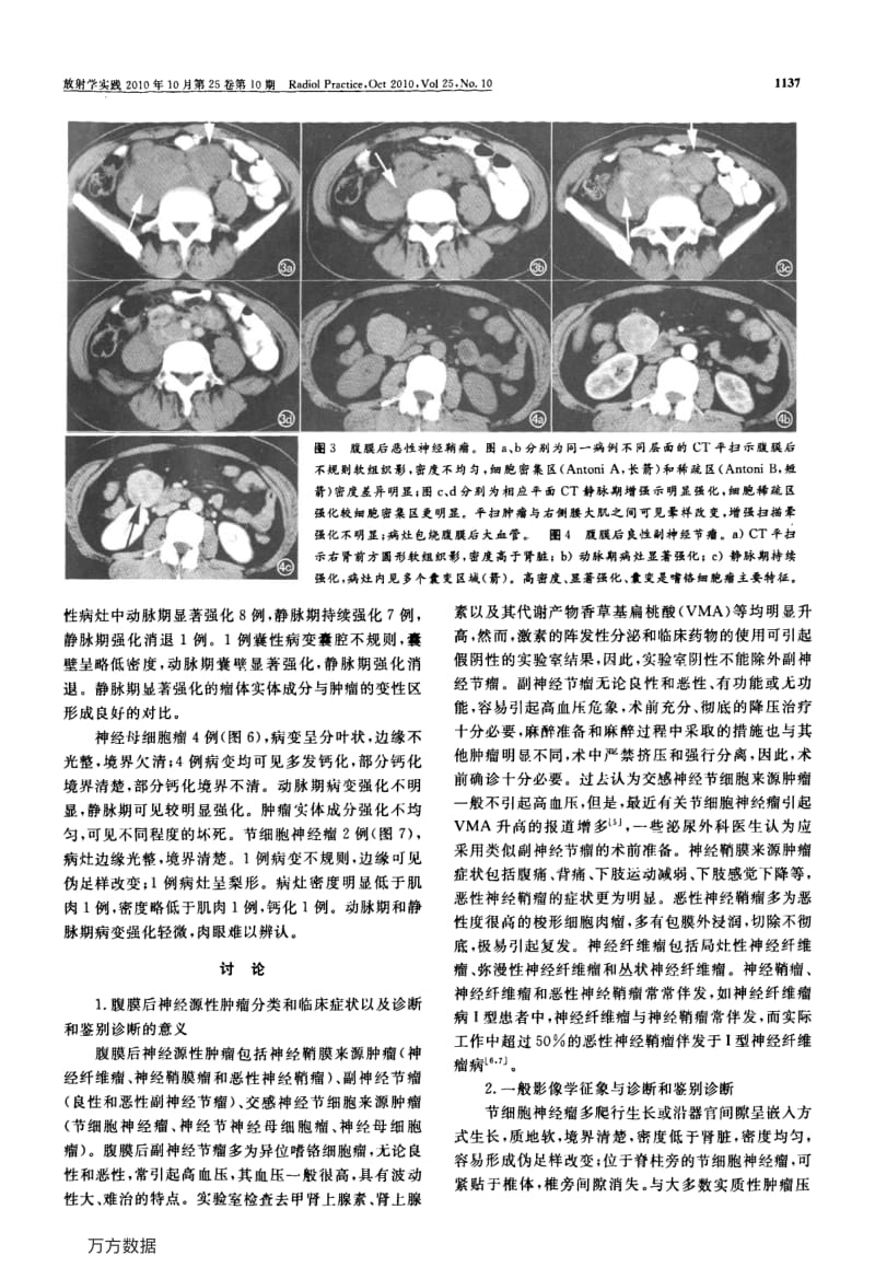 腹膜后神经源性肿瘤的分类以及CT诊断和鉴别诊断.pdf_第3页