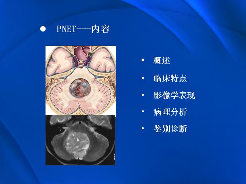 原始神经外胚层肿瘤.ppt_第2页