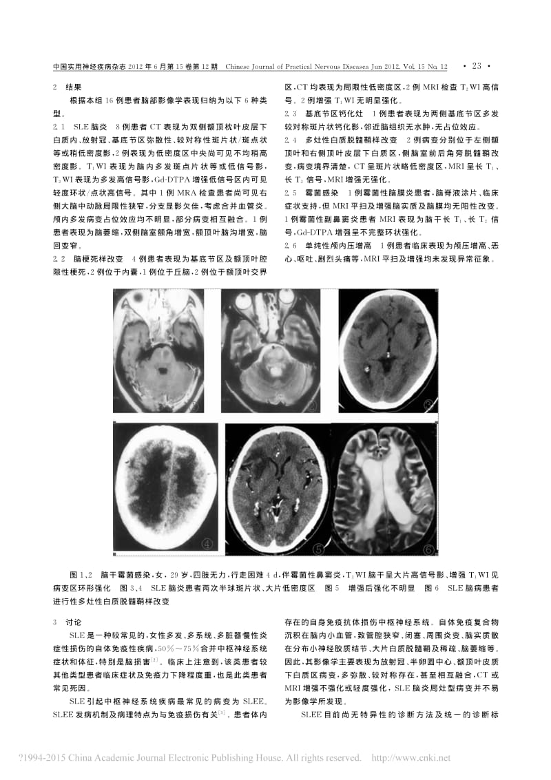 系统性红斑狼疮脑病脑部病变影像学表现.pdf_第2页