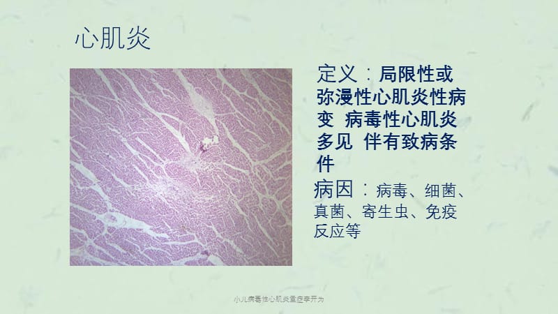 小儿病毒性心肌炎重症李开为课件.ppt_第2页