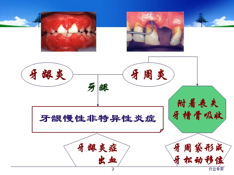 牙周病学 牙周病的主要症状和临床病理#行业严选.ppt_第2页