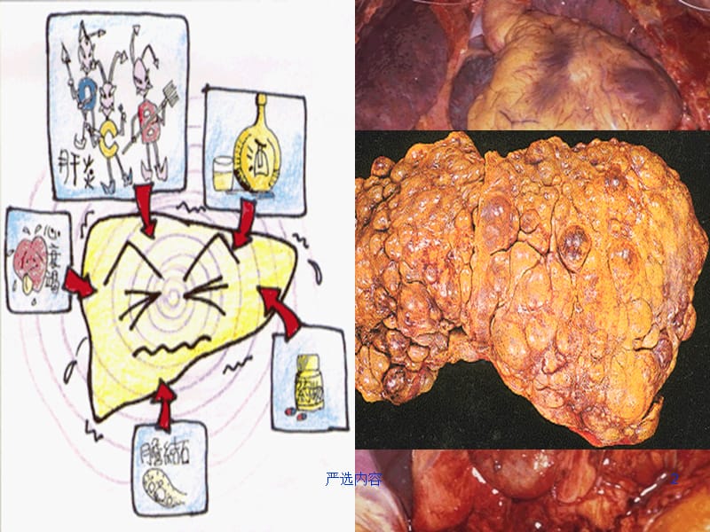 病理学肝硬化课件【优选内容】.ppt_第2页