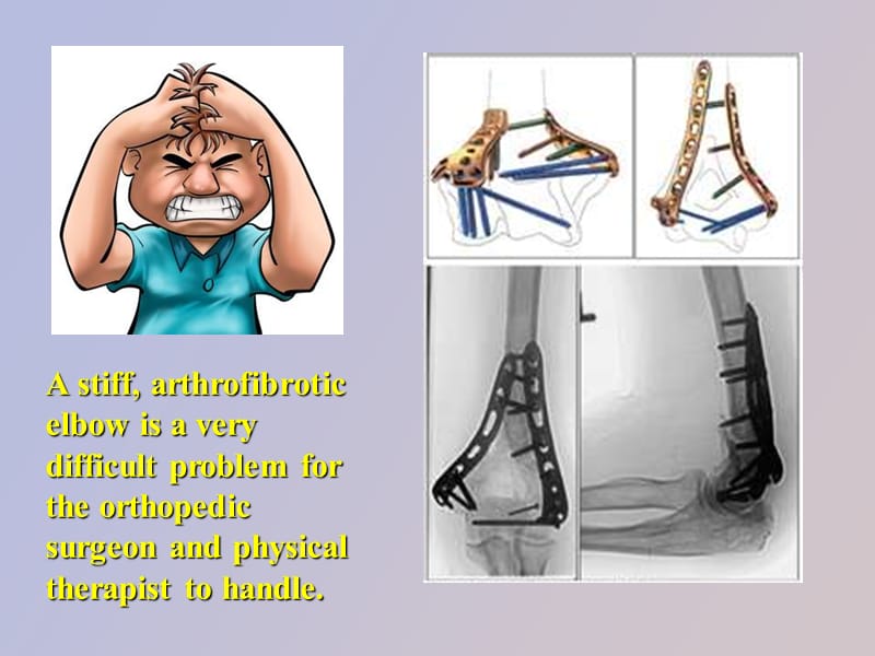 矫形器在肘关节僵直中的应用.ppt_第3页