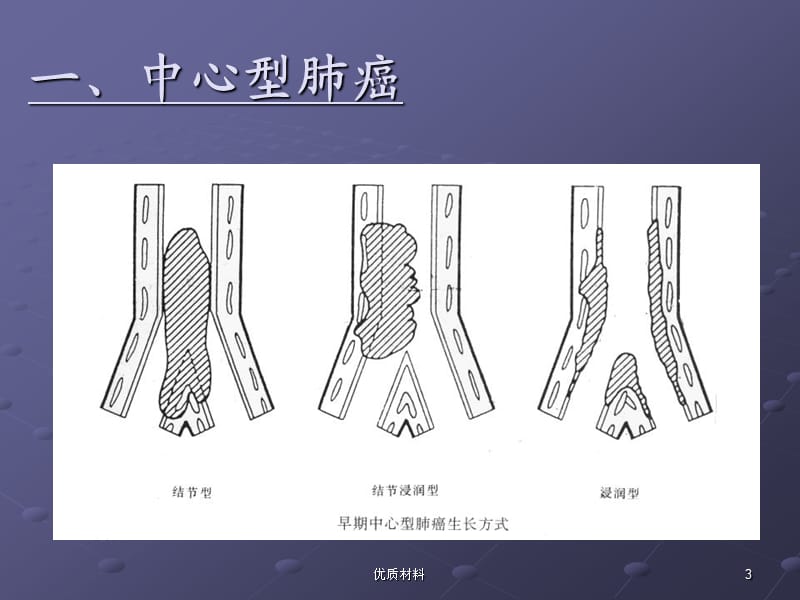 肺癌影像诊断讲课【优质借鉴】.ppt_第3页