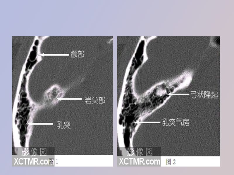 耳部解剖影像解剖.ppt_第2页