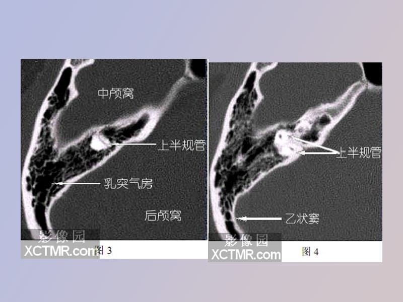 耳部解剖影像解剖.ppt_第3页