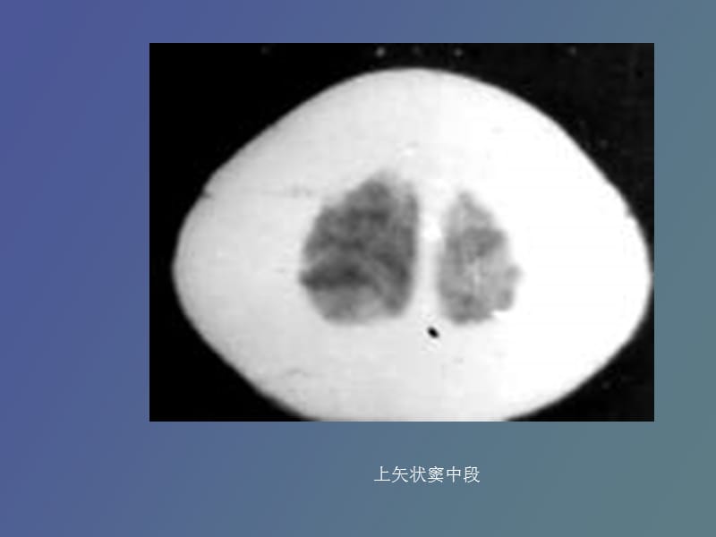 脑膜、脑池、脑室的CT解剖.ppt_第2页