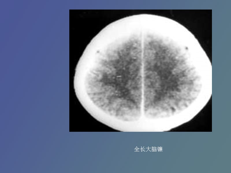 脑膜、脑池、脑室的CT解剖.ppt_第3页