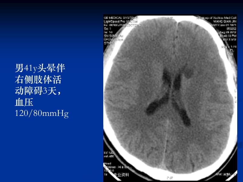 腔隙性脑梗塞【优质材料】.ppt_第3页