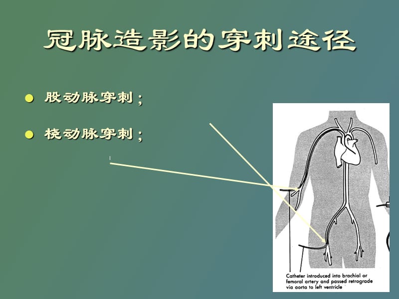 经股动脉冠脉造影术.ppt_第3页