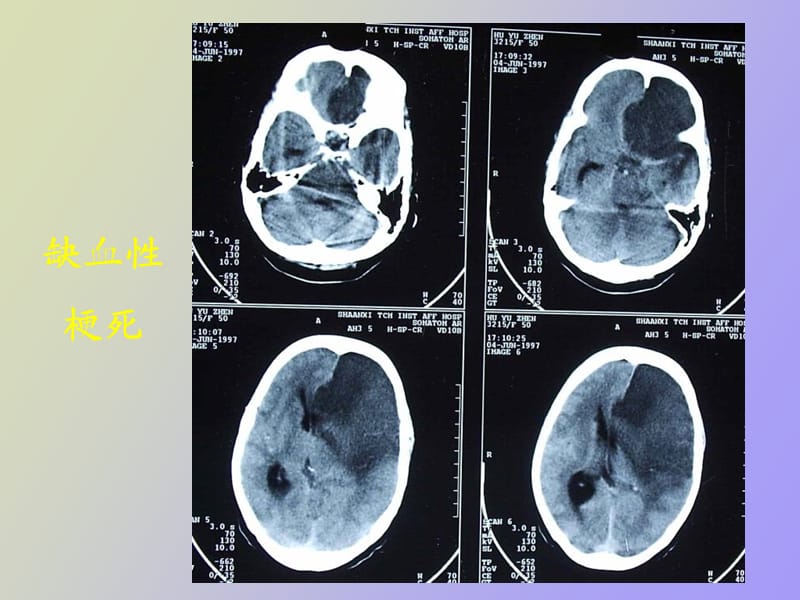 研究生医学影像学颅脑.ppt_第2页