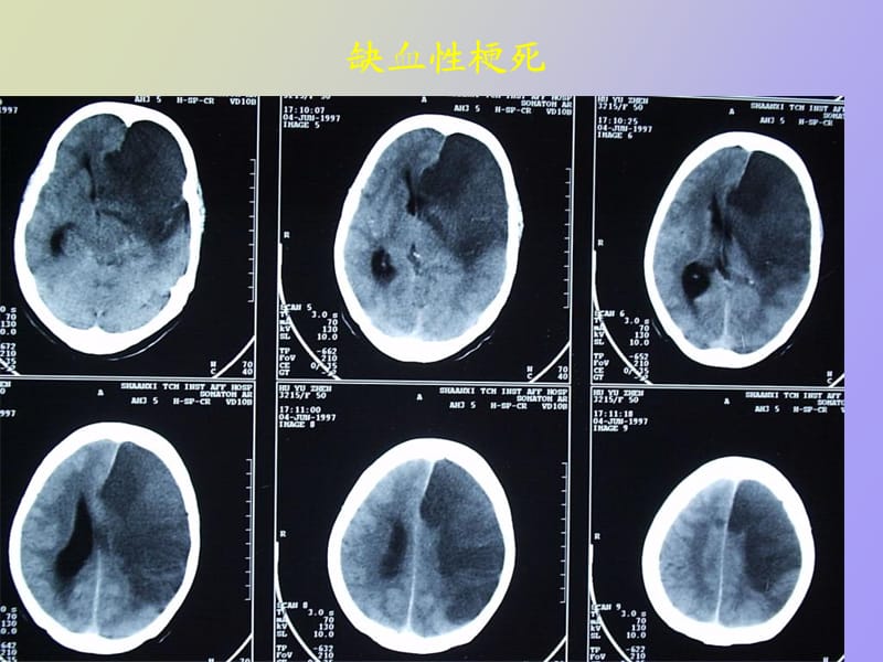 研究生医学影像学颅脑.ppt_第3页