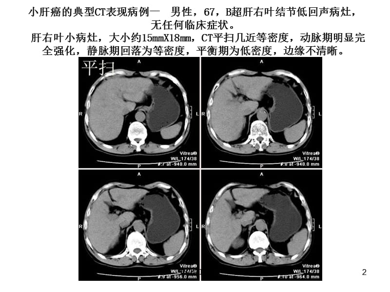 小肝癌的CT表现【专业材料】.ppt_第2页