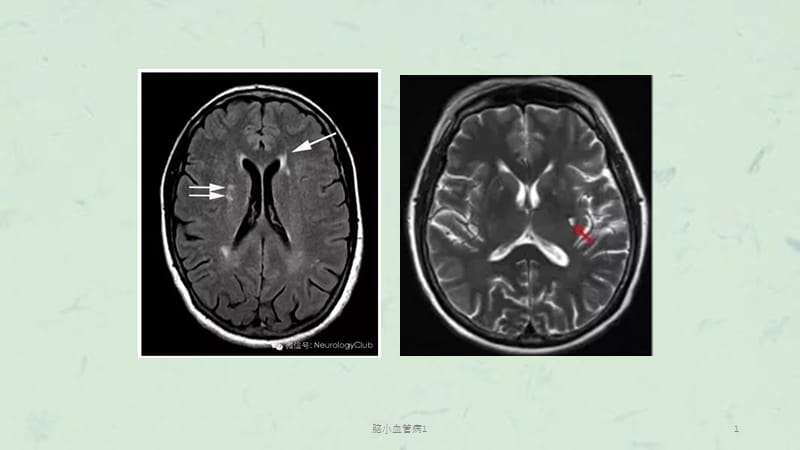 脑小血管病1课件.ppt_第1页