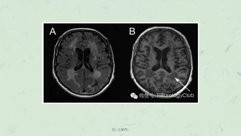 脑小血管病1课件.ppt_第2页