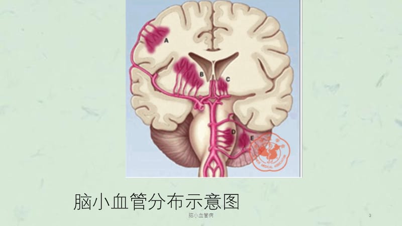 脑小血管病课件.ppt_第3页