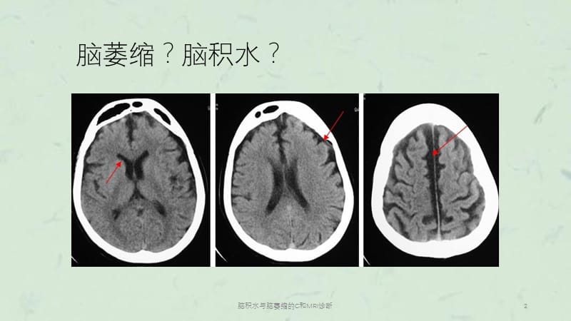 脑积水与脑萎缩的C和MRI诊断课件.ppt_第2页