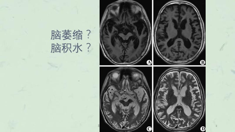 脑积水与脑萎缩的C和MRI诊断课件.ppt_第3页