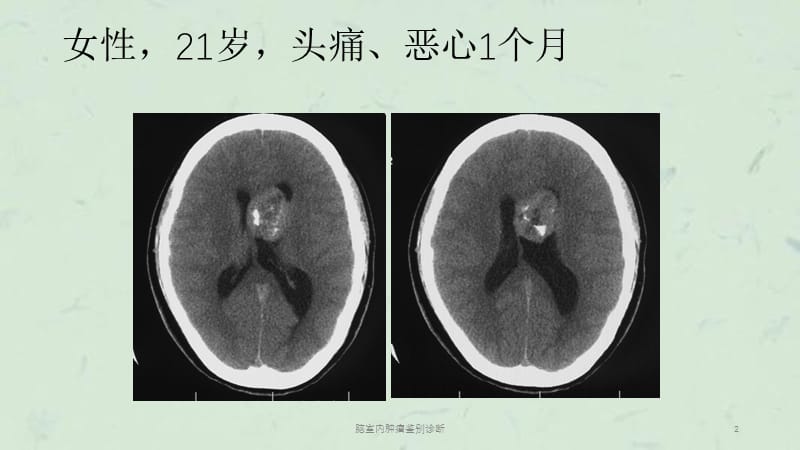 脑室内肿瘤鉴别诊断课件.ppt_第2页