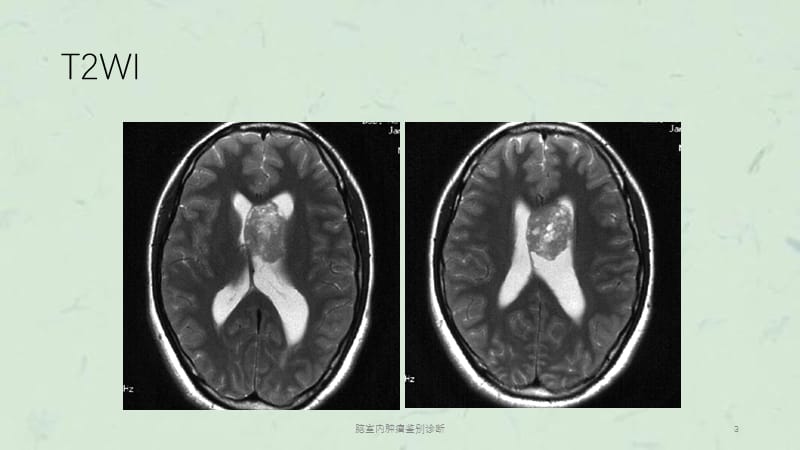 脑室内肿瘤鉴别诊断课件.ppt_第3页