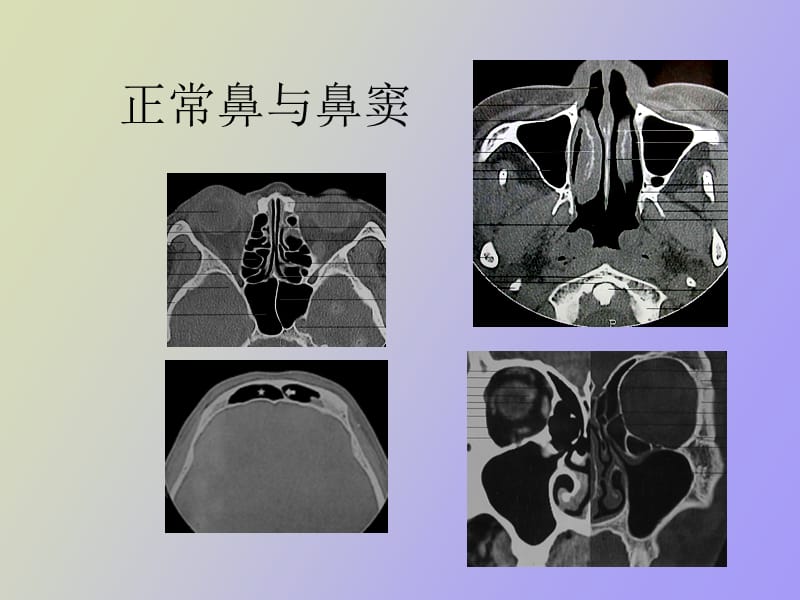 鼻副窦影像诊断ppt课件.ppt_第2页