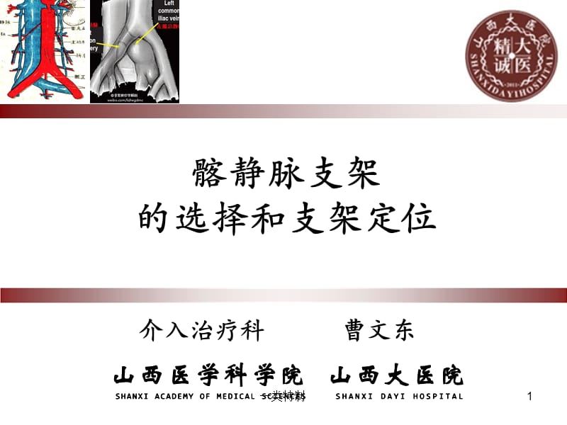 髂静脉支架的选择和支架定位【行业研究】.ppt_第1页