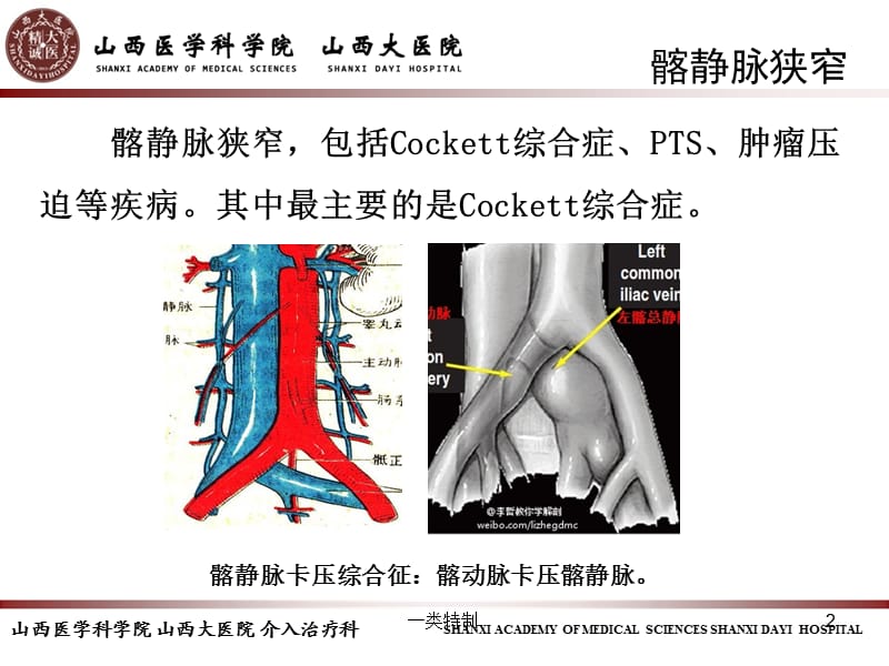 髂静脉支架的选择和支架定位【行业研究】.ppt_第2页