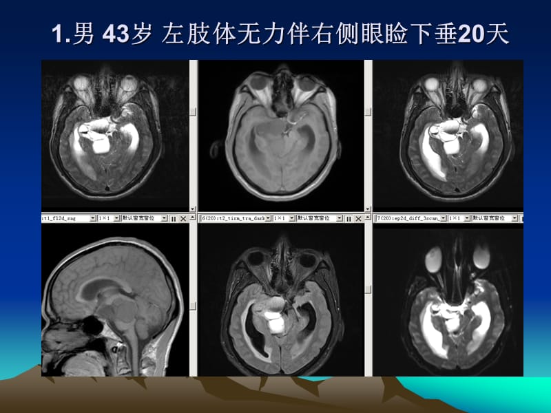 垂体瘤的MR诊断与鉴别诊断.ppt_第2页