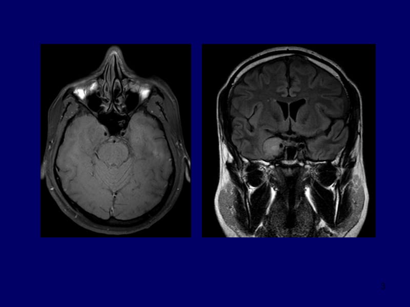 海绵窦脑膜瘤幻灯片.ppt_第3页