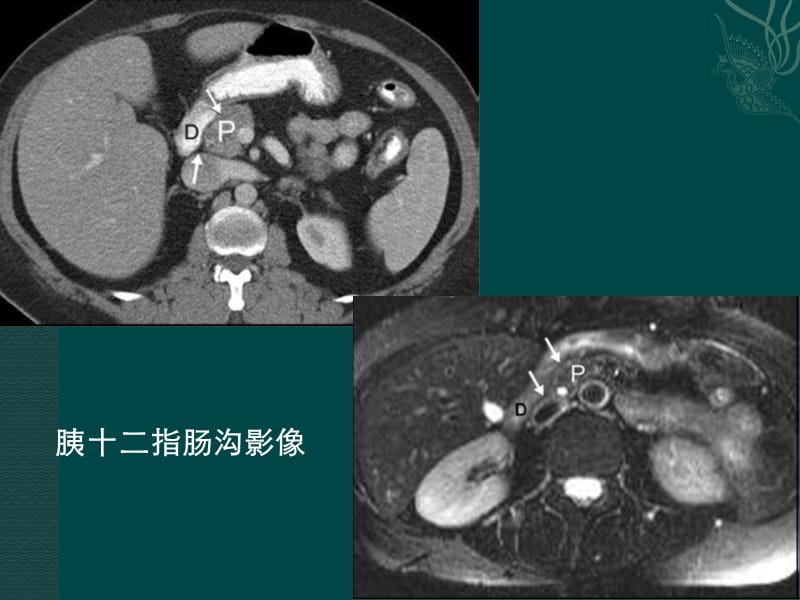 沟槽性胰腺炎.ppt_第3页