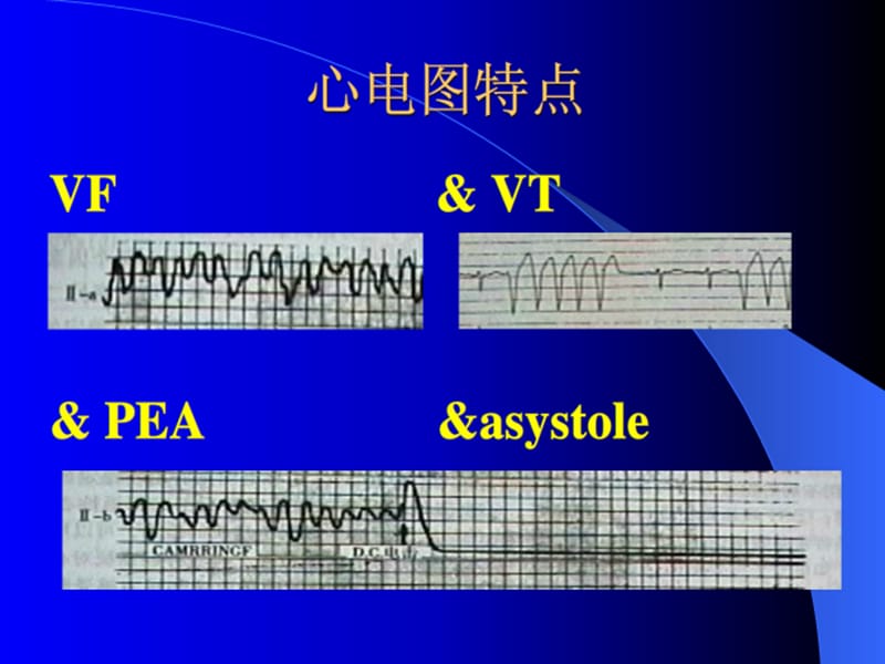 麻醉期间心跳骤停常见原因分析.ppt_第2页